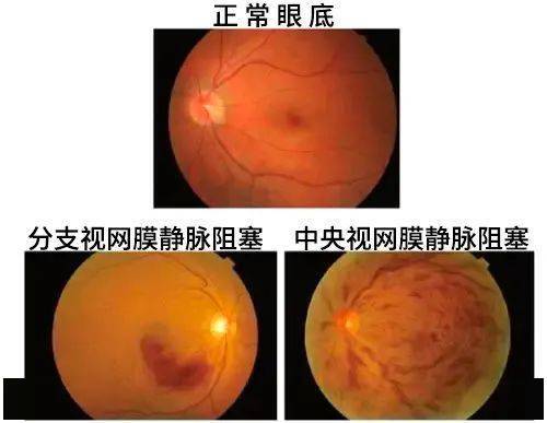 一張眼底照片藏著多少秘密?_視網膜_病變_黃斑