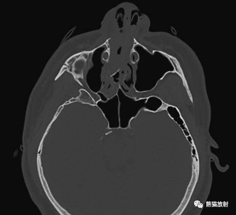 颧骨ct图片