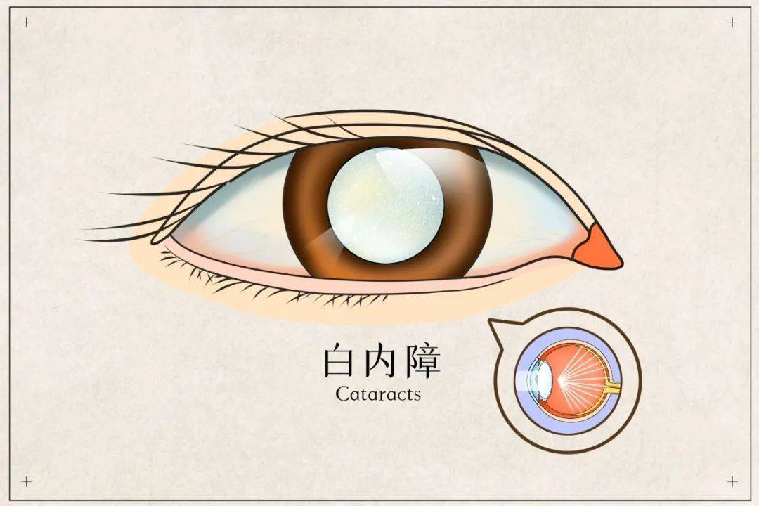 白內障 近視1000度,一次手術,雙重改善_患者_晶狀體_激光