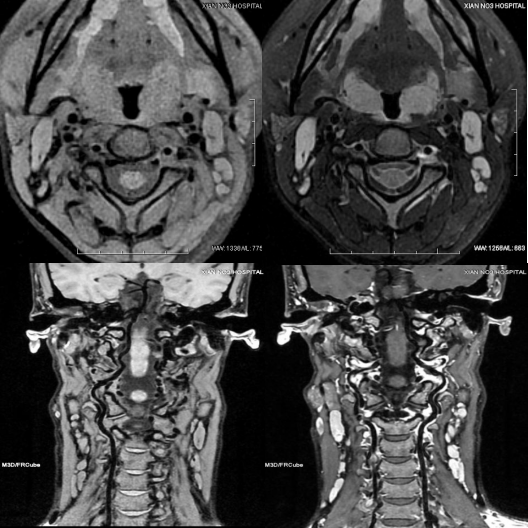 面神經,腮腺管,全脊髓神經成像:解決了由於磁場不均勻導致脂肪抑制