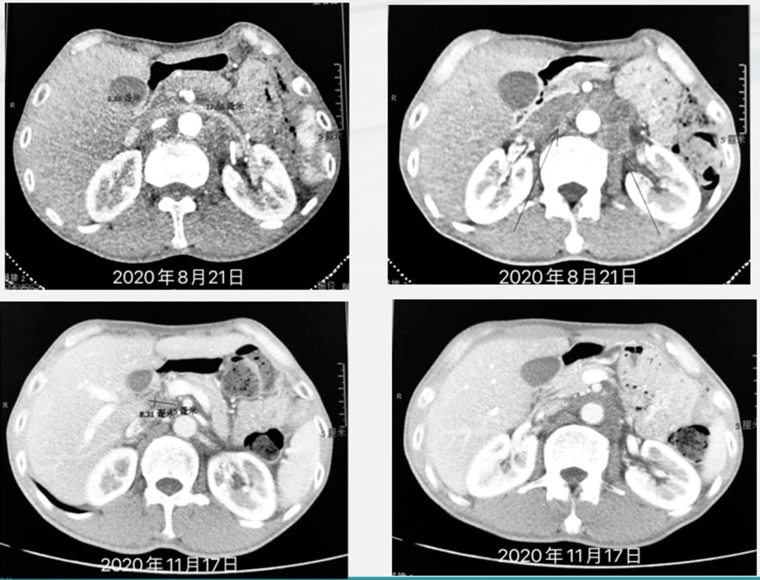 尽所能 | 存活至今,阿帕替尼联合免疫增效,"双艾" 化疗为晚期胃癌患者