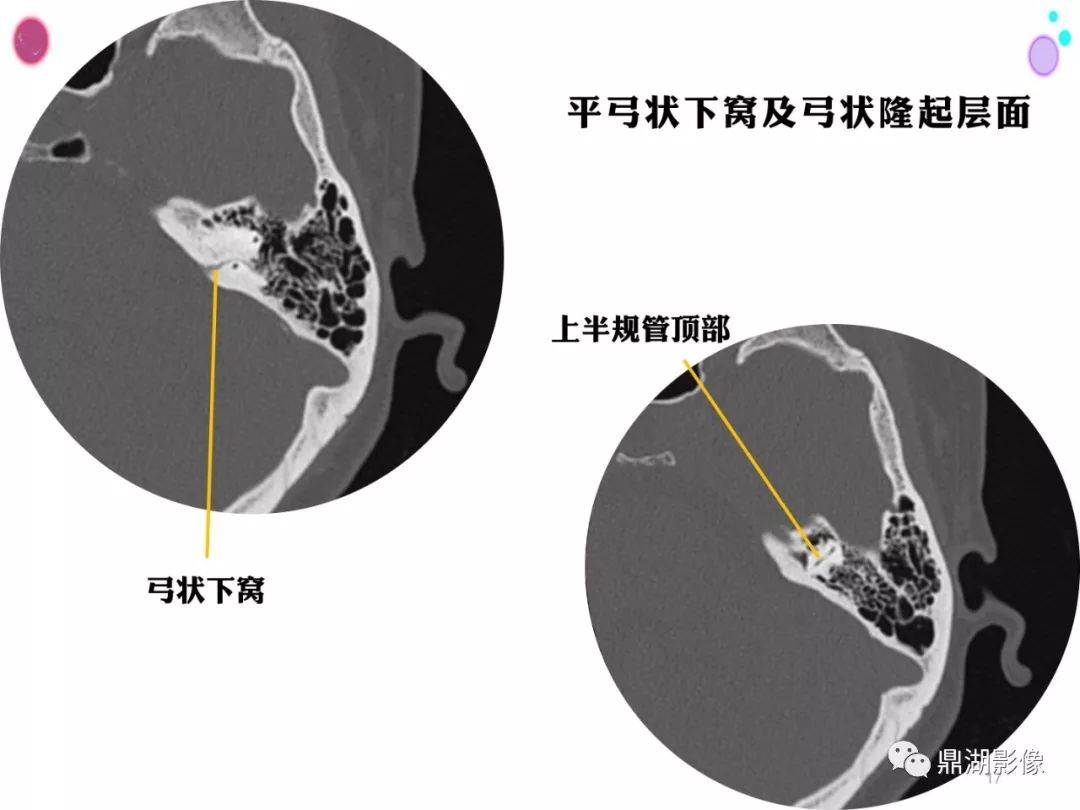 頭頸部高清ct斷層解剖(全)_全網_影像_系統