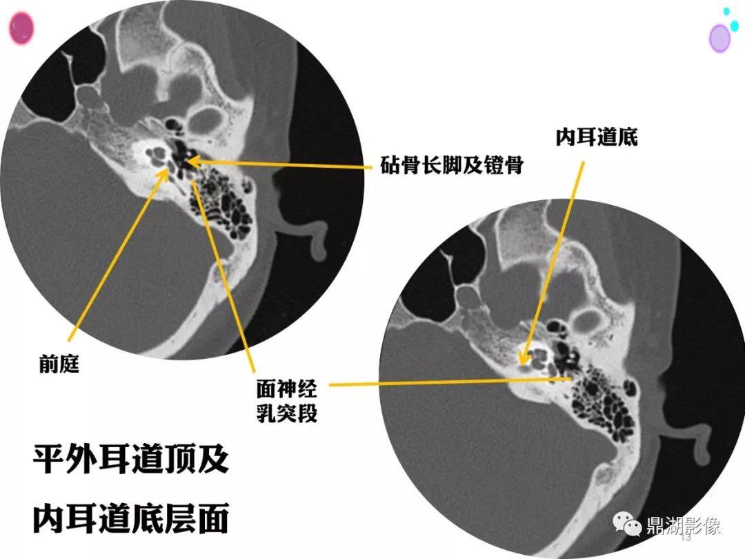 頭頸部高清ct斷層解剖(全)_全網_影像_系統